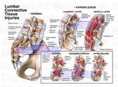 Lumbar Pain: An Overview