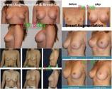 Breast Implants Bangkok Phuket, Thailand - Urban Beauty Thailand 80,000 THB/ approx. 2,667 USD