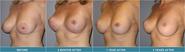 Breast Lift Thailand, Breast Augmentation - Urban Beauty Thailand 80,000 THB/ approx. 2,667 USD