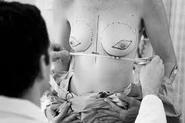 Breast Reconstructive Surgery Thailand 80,000 THB/ approx. 2,667 USD