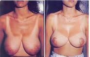 Breast Reduction Thailand - Urban Beauty Thailand 80,000 THB/ approx. 2,667 USD