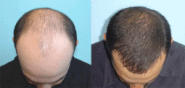 Hair Loss Regenerative Cell Therapy London