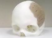Patient has 75 per cent of his skull replaced by 3D-printed implant | Information, Gadgets, Mobile Phones News & ...