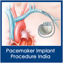 Pacemaker Implant Procedure in India-an Easy Method to Regulate Heart Beat Rhythms