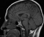 Concussions affect children's brains even after symptoms subside