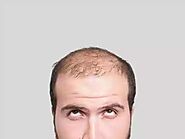 Cure for Balding? Latest Hair Loss Cure News and Studies