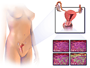 Living With Cervical Cancer