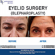 Dr Ajaya Kashyap Best Eyelid Surgeon in Delhi India