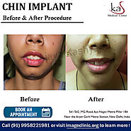 Contact Today Dr Ajaya Kashyap Best Chin Implant Surgeon in Delhi