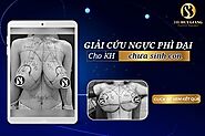 Thu gọn ngực phì đại an toàn, đẹp tự nhiên bằng công nghệ mới nhất