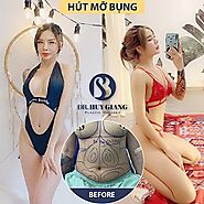 Hút mỡ bụng bằng phương pháp nào an toàn nhất? - Dr.Huy Giang