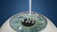 ASLA/ PRK | Freedom Eye Laser — Freedom Eye Laser