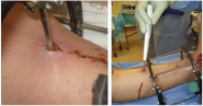Research : Prevention and Management of Complications Arising from External Fixation Pin Sites : Wisconsin Foot &...