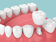 Dental Crown & Bridges in Dubai, Abu Dhabi & Sharjah | Cost & Prices