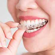 Invisalign Braces Treatment in Dubai