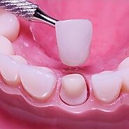 Dental crown cost in Dubai