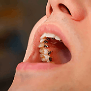 Invisible Lingual Braces in Dubai & Abu Dhabi | Lingual Braces Cost
