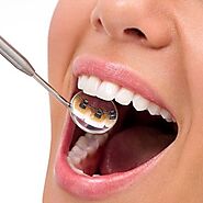 Lingual Braces Dubai Price, Abu Dhabi & Sharajh | Braces Cost