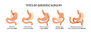 NH cares Weight Loss/Bariatric Surgery:
