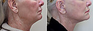 Facelift Calgary | Kristina Zakhary Medical Corp.