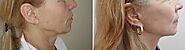 Facelift doctors in Calgary, AB | RealSelf