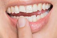 Chipped or Broken Tooth Treatment & Repair