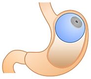 Orbera & Spatz Balloons in Mexico | HWBazaar