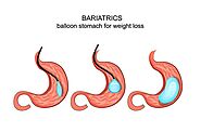 Orbera Non-Surgical Intragastric Balloon - Riverside Weight Loss Surgery