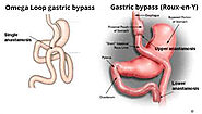 Gastric Bypass at AMOS