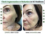 Cheek Augmentation | Dr. Parvin Shafa | Irvine skin