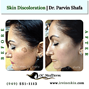 Skin Diseases - Skin Discoloration At OC MedDerm