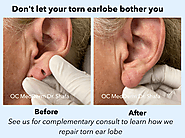 Torn earlobe repair Irvine & Orange County