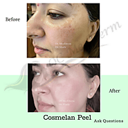 Cosmelan peel treatment - Dr. Parvin Shafa Orange County