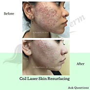 Co2 Laser doctor near Irvine ca - Dr. Parvin Shafa