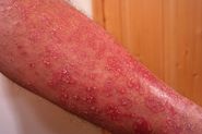Psoriasis - Topic Overview | WebMD