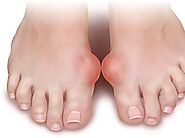 The End of Gout eBook PDF by Shelly Manning