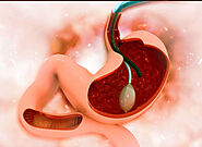 Cost of Gastroscopy in Singapore? Is Gastroscopy An Expensive Procedure