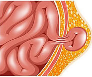 Choosing the Right Specialist for Hernia Care in Singapore