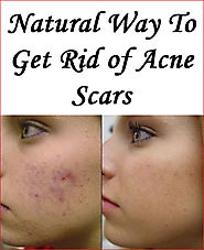 How To Get Rid Of Acne Scars Naturally? Best Acne Scar Treatment