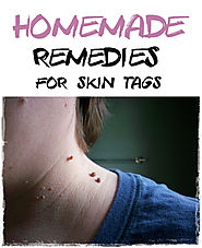 12 Natural Remedies For Skin Tag Removal (Home Remedies)