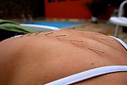 Acupuncture: An Ancient Treatment for a Current Problem | Spine-Health