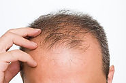 Some Advisable Hair Loss Treatment And Solutions
