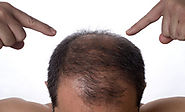 Have Proper Nutrient Food And Avoid Hair Loss