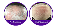 Avoid Hair Loss By Advanced Treatment