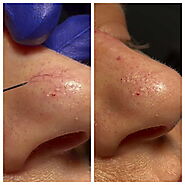 Blood Vessel Treatment | Vein Treatments (Sclerotherapy)