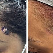 Mole Removal & Mole Removal on Face St. Louis