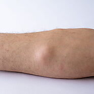 Lipoma Removal & Lipoma Surgery St. Louis