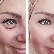 Eyelid Surgery & Blepharoplasty St. Louis, Missouri