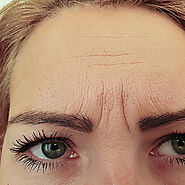 Frown Lines St. Louis – How to Get Rid of Frown Lines