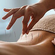 Acupuncture for Anxiety | BWM Acupuncture